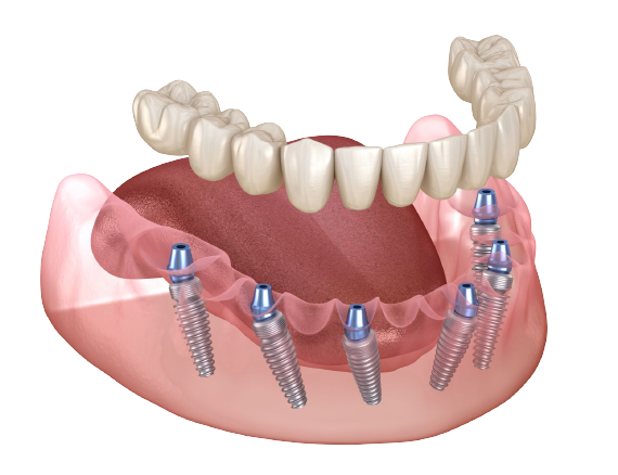 All-on-6 implants serve as sturdy and enduring supports for your replacement teeth, ensuring their strength and durability.