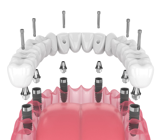 All_on_4_dental_implant-bg
