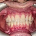 Teeth after Invisalign | MyHealthcare Clinic