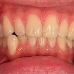Teeth before Invisalign | MyHealthcare Clinic