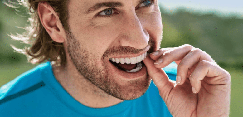 Invisalign Male