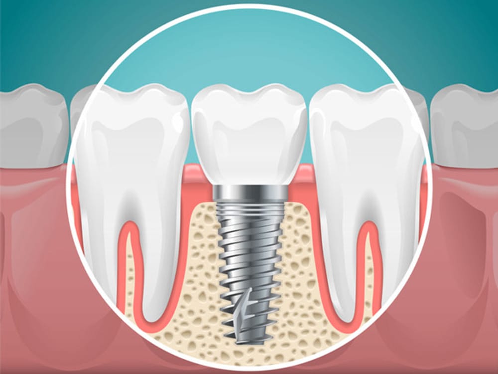Dental Implants are durable and cost-effective solutions for replacement teeth.
