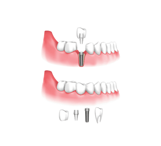 dentalimplantsill dentalimplantsill