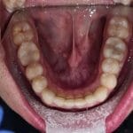 Bottom teeth after Invisalign | MyHealthcare Clinic