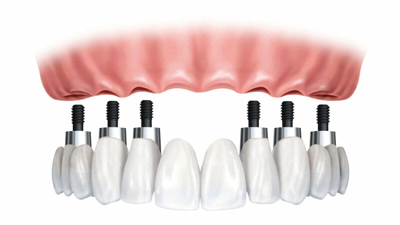 full-mouth-dental-implants-6