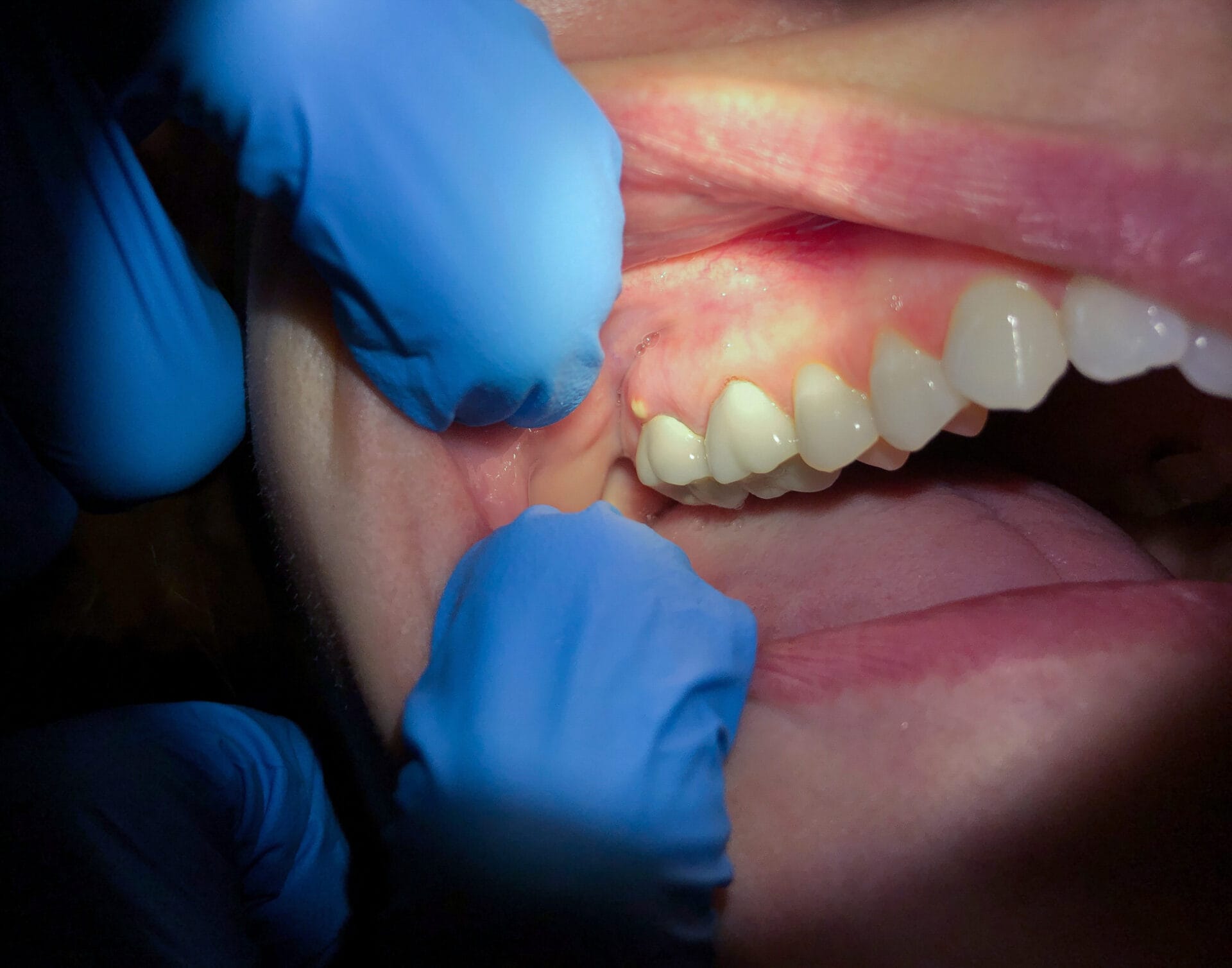 dental-abscess-myhealthcare-clinic