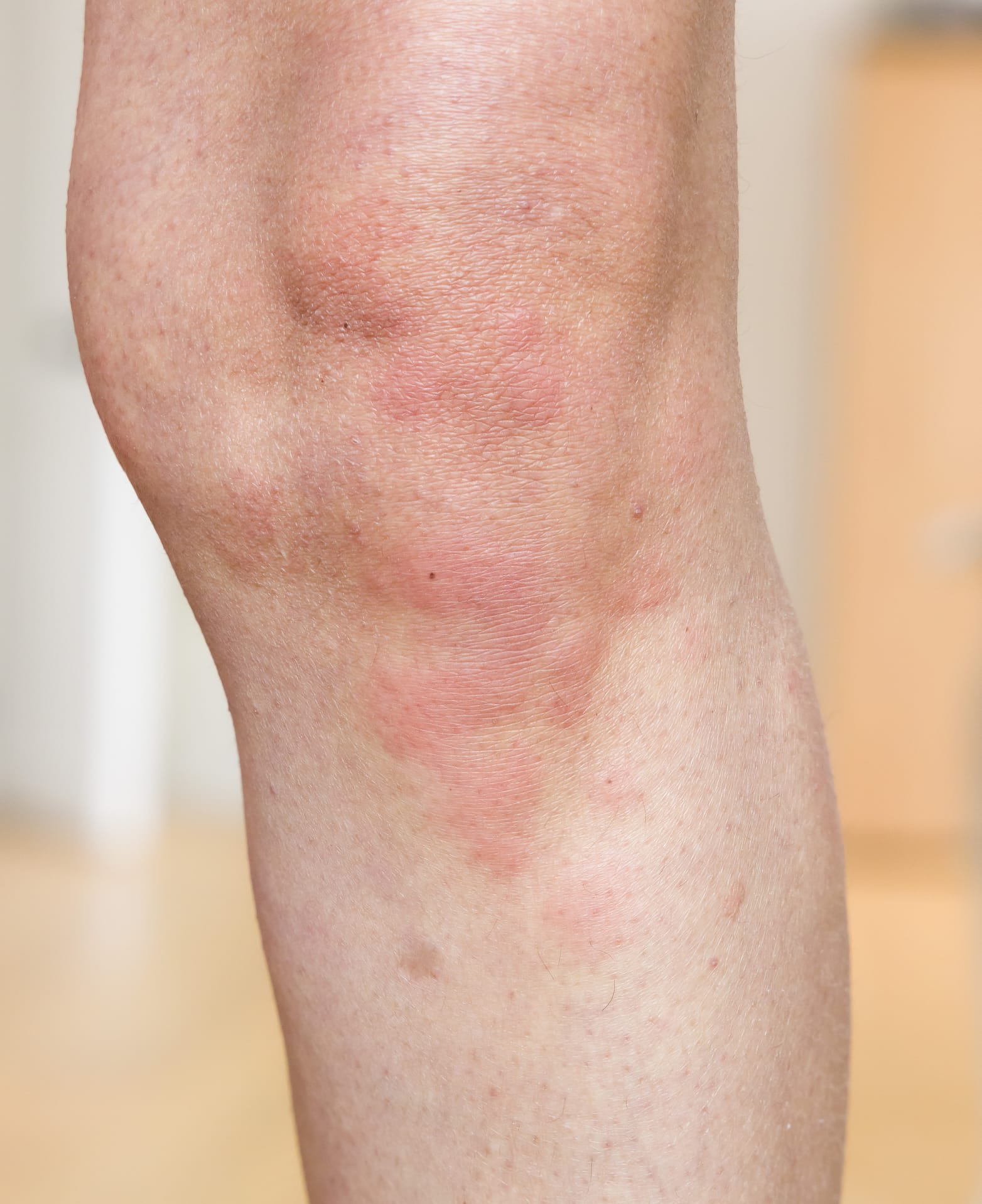 Heat Rash (Prickly Heat) Symptoms, Treatment and Causes MyHealthcare