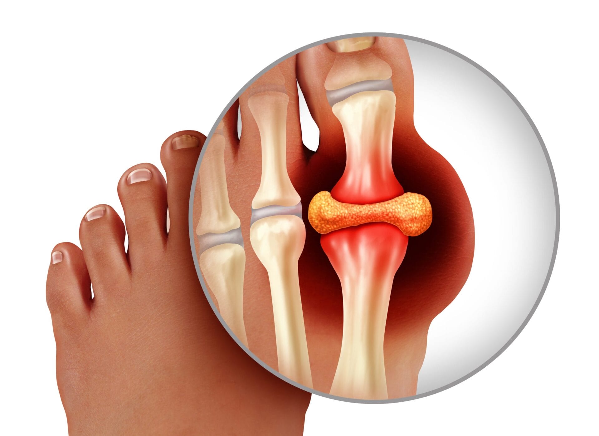 gout-symptoms-treatment-causes-myhealthcare-clinic