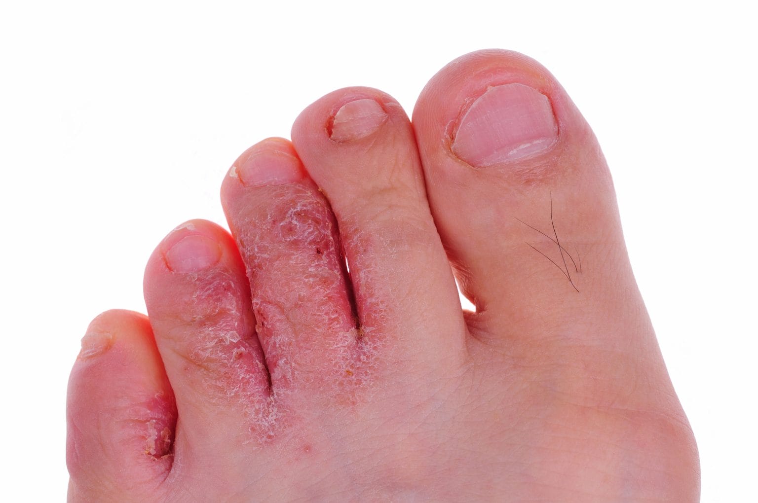 Athletes Foot Symptoms Treatment And Causes Myhealthcare Clinic