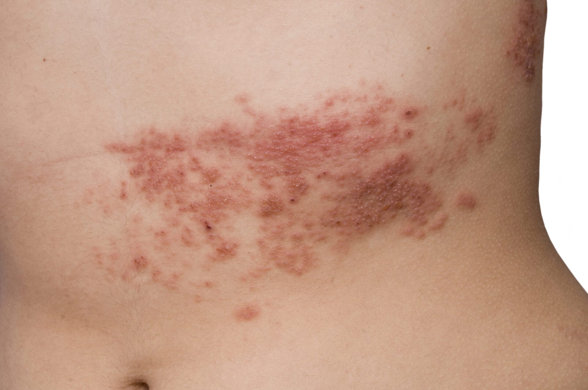 Shingles Inferior Shingles: Symptoms, Treatment and Causes | MyHealthcare Clinic